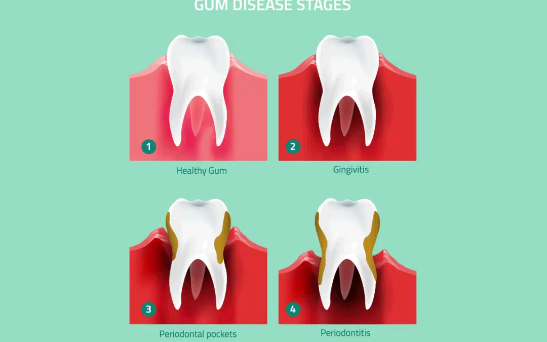 How Can I Avoid Gum Disease?