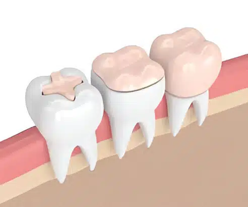 Understanding the Difference: Dental Crowns vs. Fillings